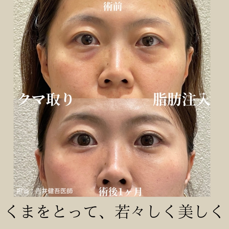 大阪吹田江坂でクマ取りを検討中の方へ。気になる「ダウンタイム」のリアルと抑えるコツについて