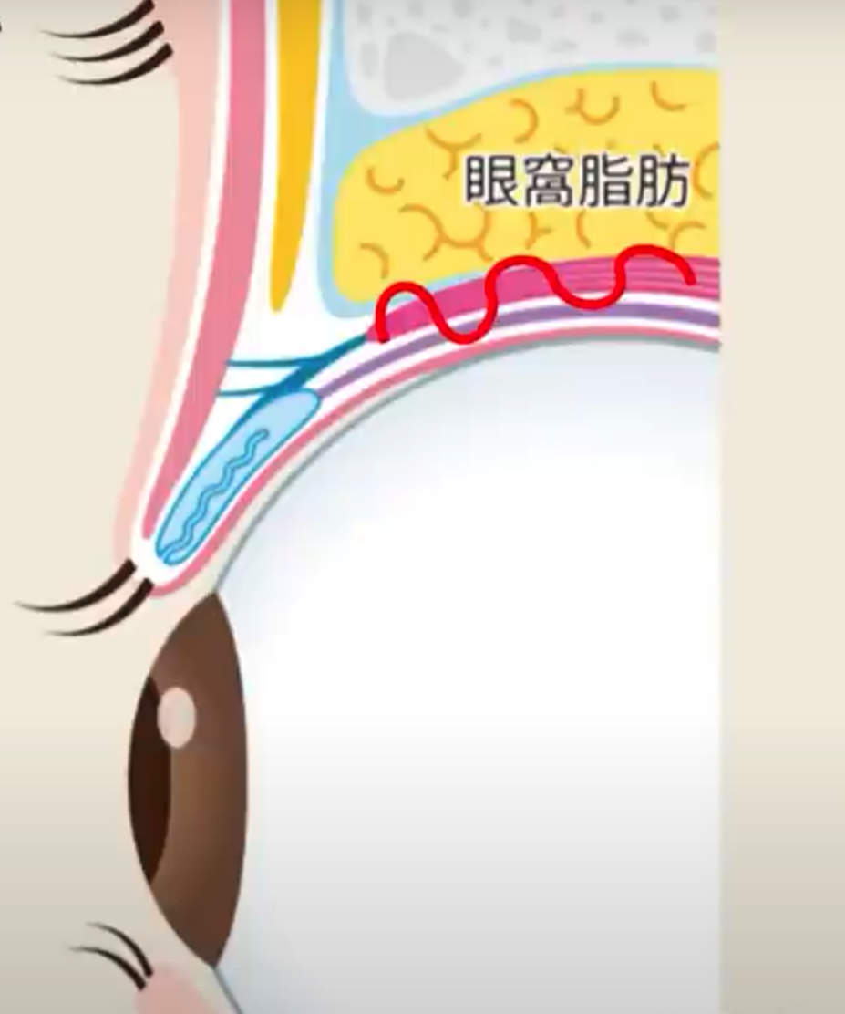 眼瞼下垂の原因
